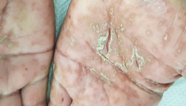 צורות קליניות  שונות  של  מחלות  הפסוריאסיס  בכפות הידיים